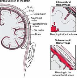 Common Questions What is an SAH? A subarachnoid haemorrhage (haemorrhage = bleeding) is a sudden leak of blood over the surface of the brain.