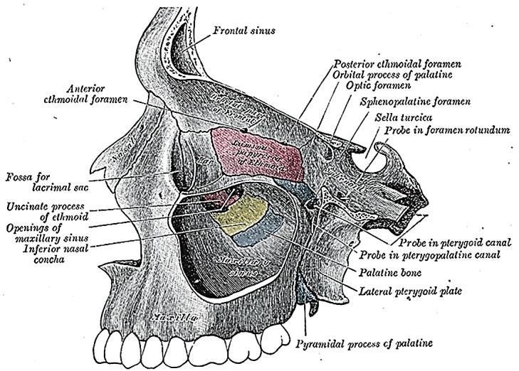 Pterygoid canal Pterygopalatine canal Palatine bone Lateral pterygoid plate Figure 1: Bilateral inferior maxillectomy A sound understanding of the 3- dimensional anatomy of the maxilla and the