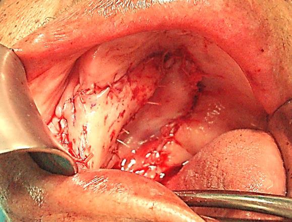 Figure 30a: Minor salivary gland tumour of
