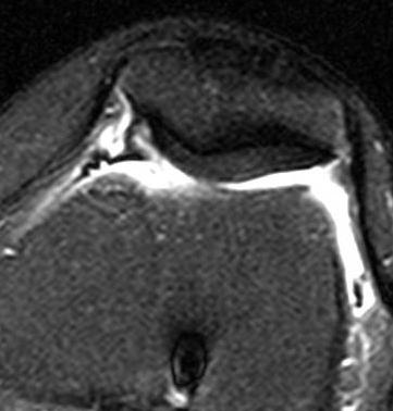 impingement lesion MR Findings appearance does not correlate