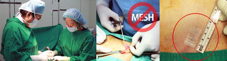 3 The duration of surgery is very short. It takes about 20 minutes. There is no process of inserting artificial mesh so that the duration of surgery can be shorter.