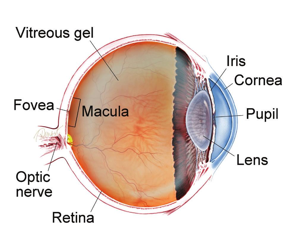 There are 2 types of AMD: non-neovascular or dry AMD; and neovascular or wet AMD. In early stages of dry AMD, the hallmark is drusen pale yellow lesions formed beneath the retina (Figure 1A).