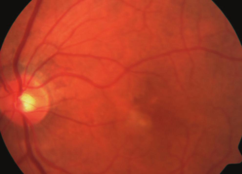 GA is the advanced form of dry AMD, which is frequently associated with loss of central vision.
