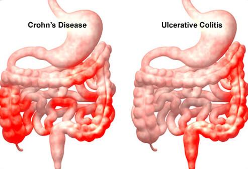 Inflammatory Bowel Disease (IBD) Individuals with IBD are at an increased risk for colorectal cancer. Most experts recommend people with IBD to start having colon cancer screening early and often.