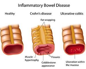 Inflammatory Bowel Disease (IBD) is a group of disorders that cause swelling and inflammation in the intestines, affecting as many as 3 million Americans.