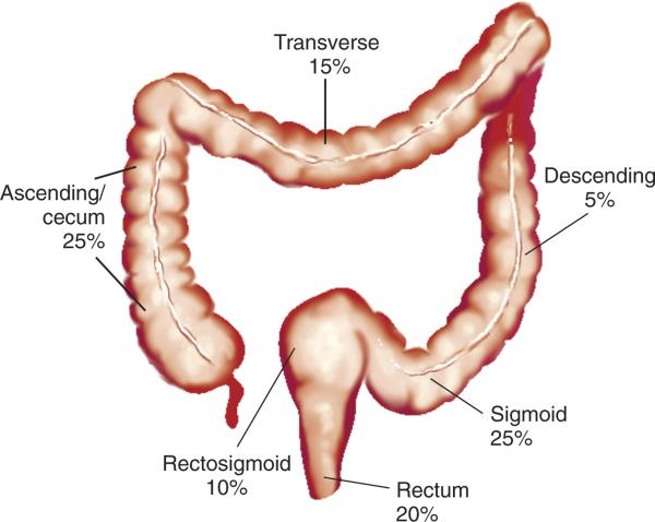 Common Colorectal Cancer Symptoms Some of the symptoms below, such as diarrhea or rectal bleeding, can be early warning signs of CRC in the general population.