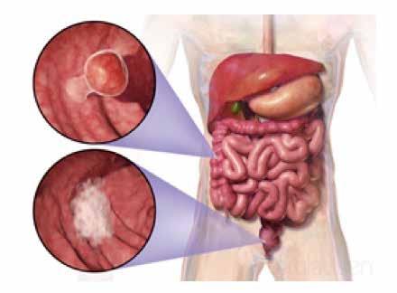 Protecting Yourself From Colorectal Cancer Colorectal cancer often derives from preexisting colon polyps.