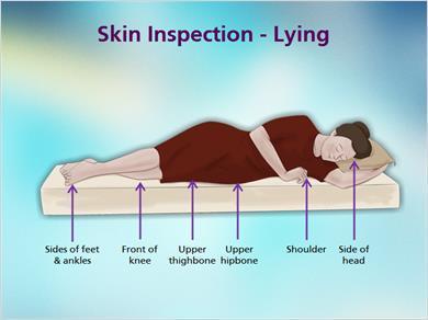 1.8 Skin Inspection 4 JILL: And finally, for individuals lying on their side, here are the places where you should regularly inspect their skin for signs of developing pressure ulcers.