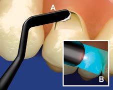 ne Bulk Fill ne Bulk Fill 3 Questions and Answers Anterior Restorations For anterior restorations that are 3 mm or less in depth, a single cure of the material is sufficient.