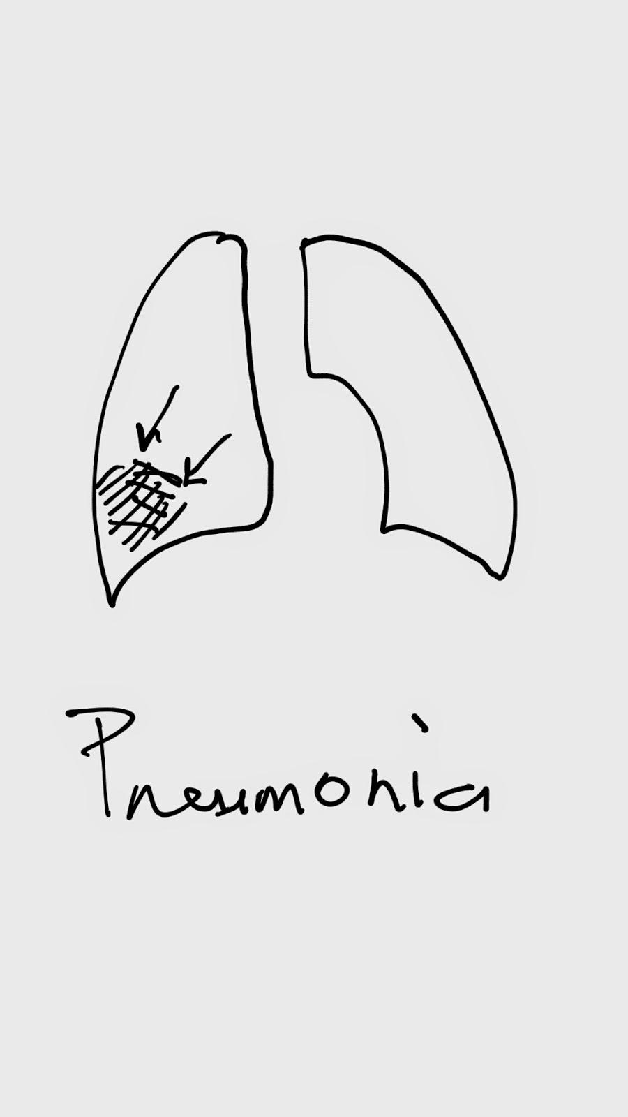 Pneumonia Pnemonia