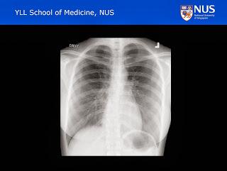 Section 4: (e)lecture proper We will focus on two major areas. Firstly review basic principles of CXR production and interpretation.