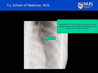 We use the silhouette phenomenon on a CXR to detect the edge between the normal left heart border, and adjacent aerated normal lung which contains air.
