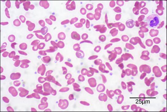OpenStax-CNX module: m44402 10 Figure 6: In this blood smear, visualized at 535x magnication using bright eld microscopy, sickle cells are crescent shaped, while normal cells are disc-shaped.