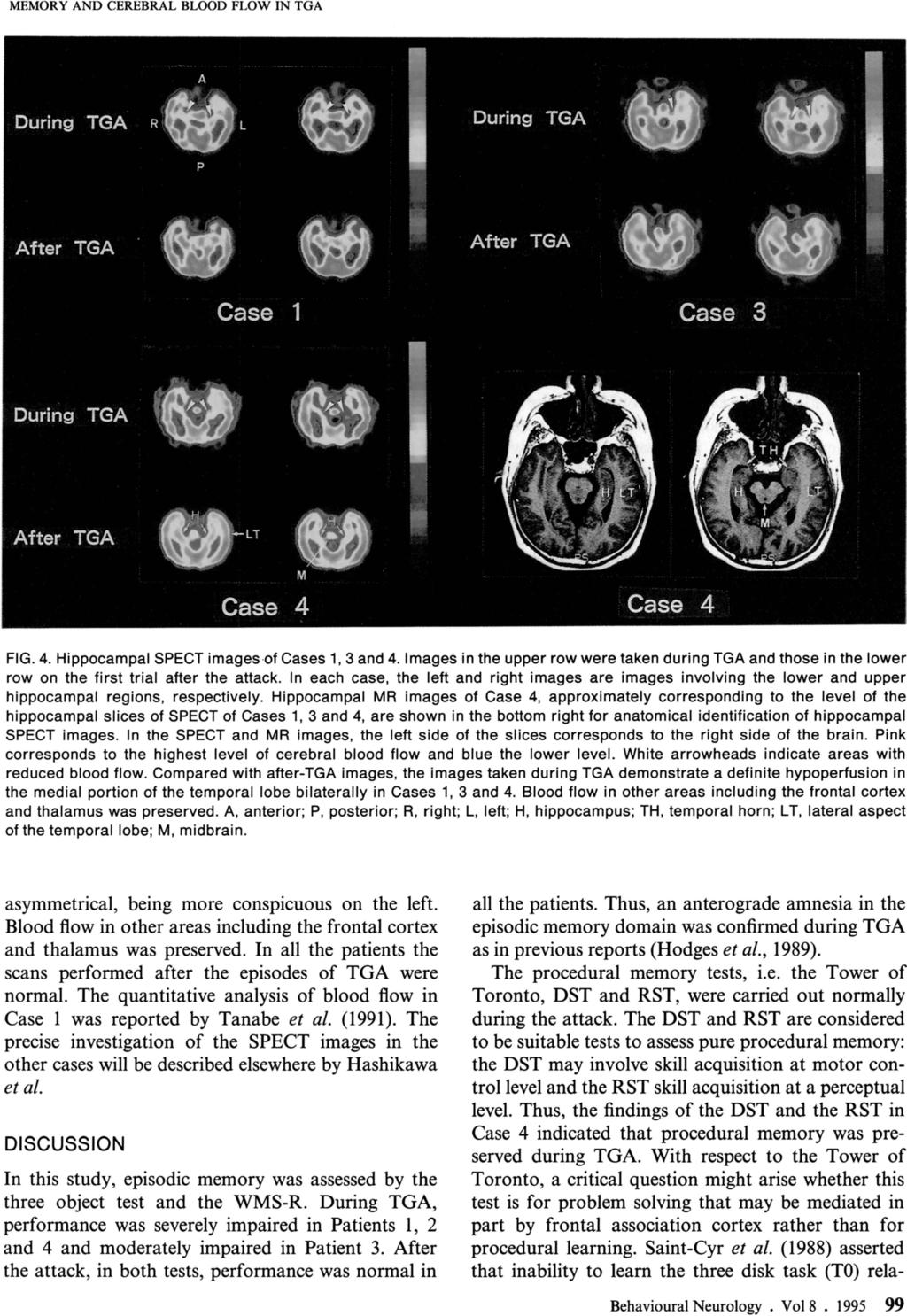 MEMORY AND CEREBRAL BLOOD FLOW IN TGA FIG. 4. Hippocampal SPECT images of Cases 1, 3 and 4.