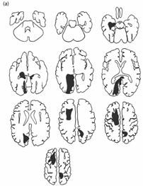 Human, brain damage, and amnesia /Amnesics can learn new information Human, brain damage, and amnesia /The perceptual representation system (PRS) (1/3) Patient K. C.