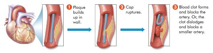 Heart Disease If the cap on a plaque ruptures, a blood clot may form that completely blocks an artery.