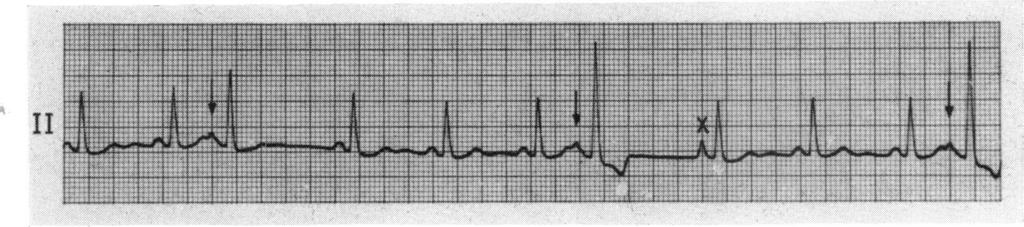 3). When this occurs, aberrant atrial conduction is much more conspicuous in the first sinus P wave than in the second sinus P wave (Fig. 3).