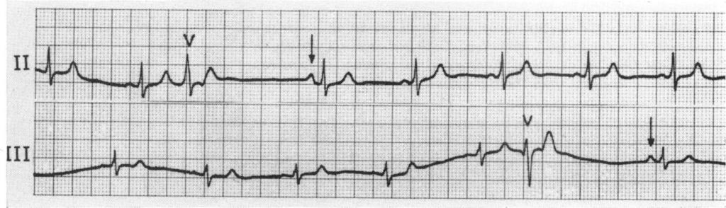 3) Aberrant atrial conduction after ventricular atrial conduction occurs, it is more commonly premature contractions seen after atrial parasystolic beats (Fig. 6).