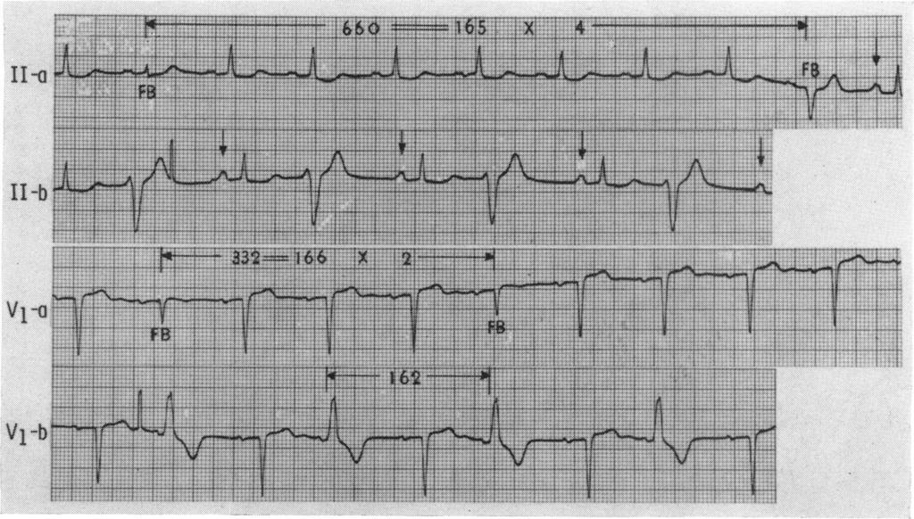 The tracing reveals sinus rhythm with atrial parasystole (indicated by arrows) and occasional ventricular premature contractions.
