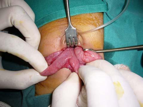 Vitello-intestinal Duct remnants Treatment is surgical.