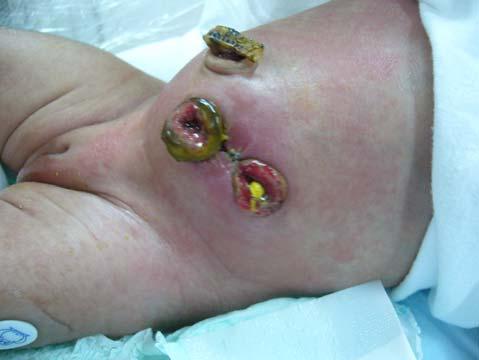 Hirschsprung s Disease Initial treatment: