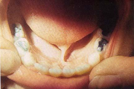 Tongue Tie (Ankyloglossia) Short lingual frenulum Inserts at or near the