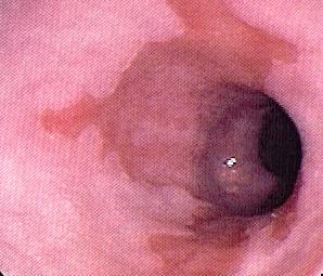 endoscopy Stricture