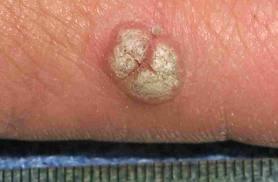 HPV - Genital Warts Genital warts are growths on or around the genitals or anal area in both males and females that are caused by HPV. The warts can be different sizes.