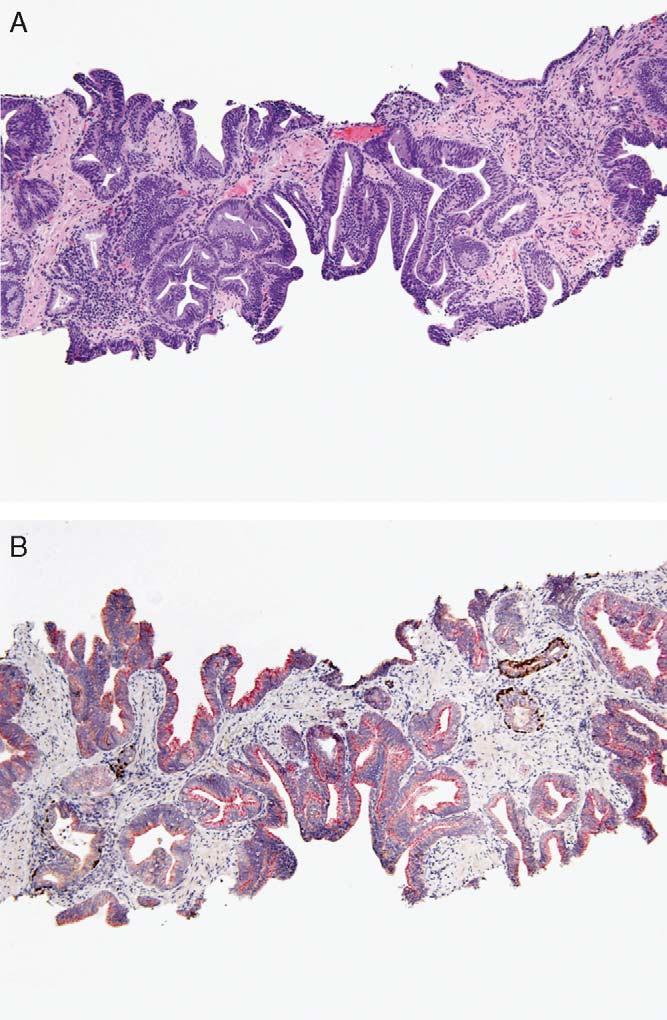Tavora and Epstein Am J Surg Pathol Volume 32, Number 7, July 2008 involved by tumor, a larger number of malignant glands were required to reach the diagnosis.