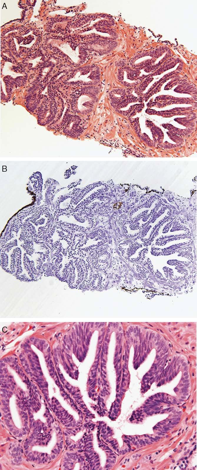 B, p63 immunohistochemical study showing absence of basal cells in PIN-like ductal adenocarcinoma glands. showing proximity and others away from PIN-like ductal adenocarcinoma.