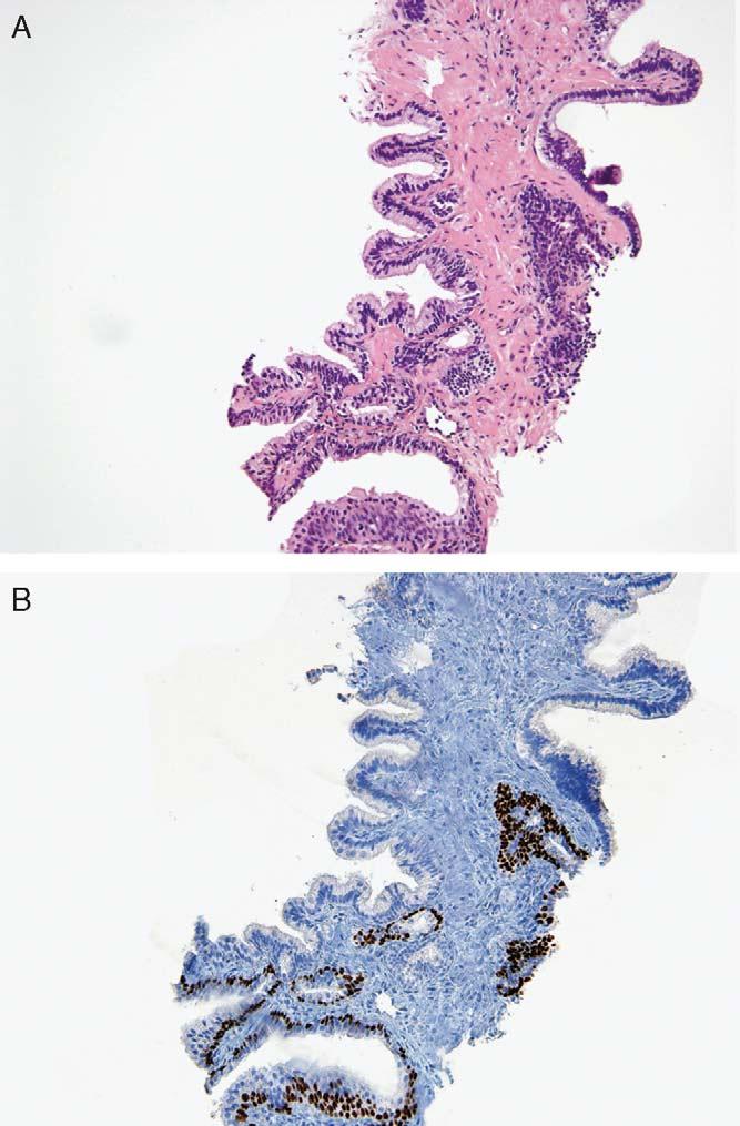 Tavora and Epstein Am J Surg Pathol Volume 32, Number 7, July 2008 FIGURE 5. A, On both sides of the needle core, strips of malignant epithelium suggest the presence of cystically dilated glands.