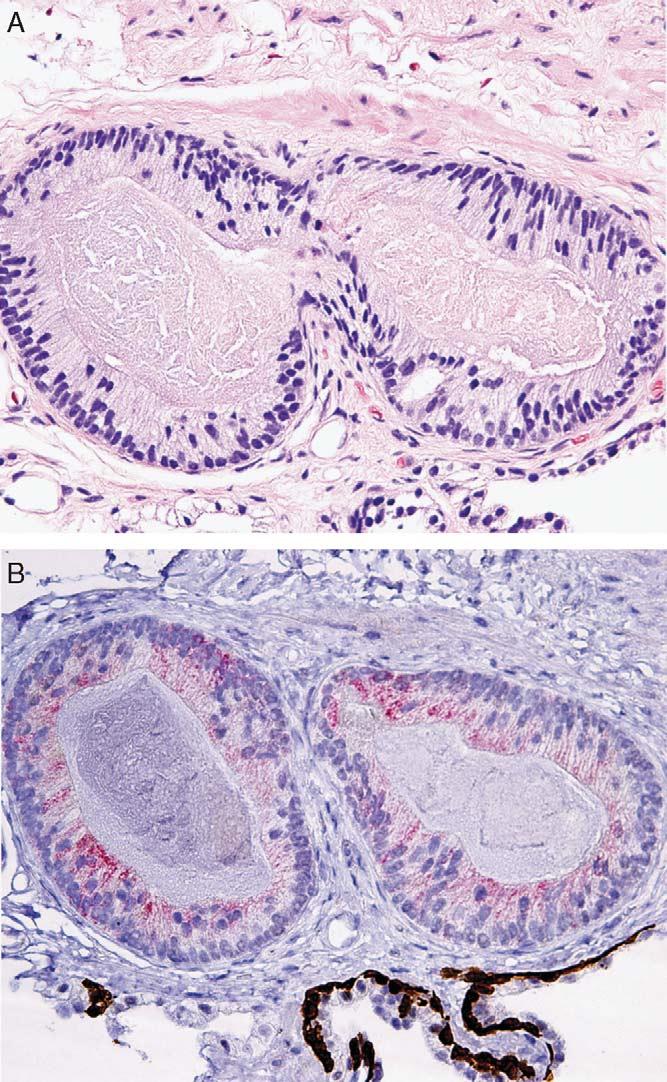 The only case without immunohistochemistry was diagnosed based on the presence of well-established micropapillae and presence of numerous glands lined by atypical columnar cells which resembled