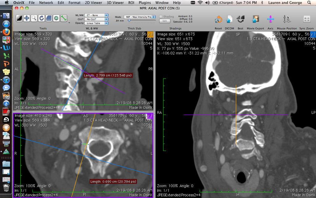 axial image CT angio