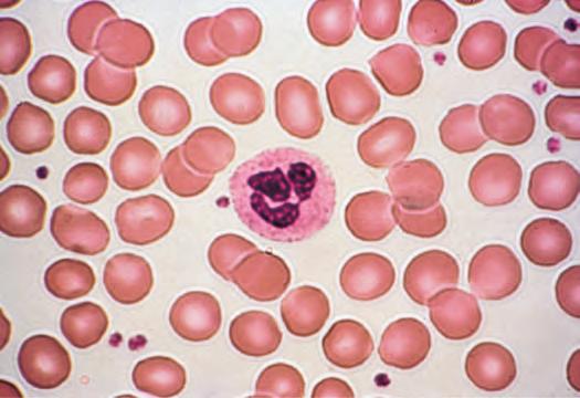 TABLE 77-1 Laboratory Tests in Anemia Diagnosis I. Complete blood count (CBC) A. Red blood cell count 1. Hemoglobin 2. Hematocrit 3. Reticulocyte count B. Red blood cell indices 1.