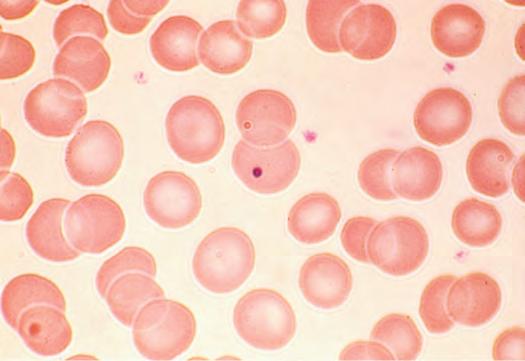 Often macrocytes are oval shaped (macro-ovalocytes). Figure 77-8 Target cells.