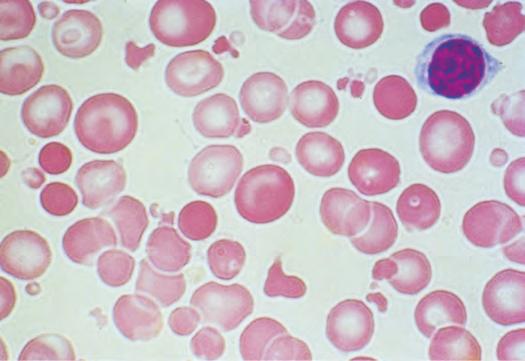 Red cells may become fragmented in the presence of foreign bodies in the circulation, such as mechanical heart valves,
