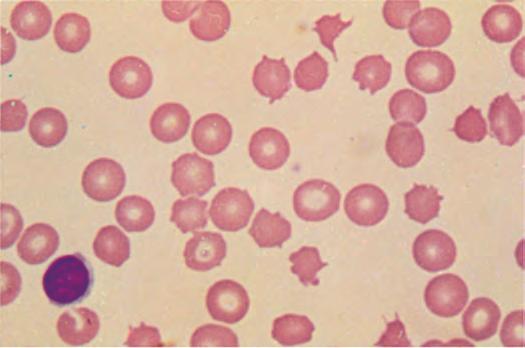 Figure 77-11 Spur cells. Spur cells are recognized as distorted red cells containing several irregularly distributed thornlike projections.