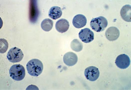 ) have been recently released from the bone marrow. They are identified by staining with a supravital dye that precipitates the ribosomal RNA (Fig. 77-12).