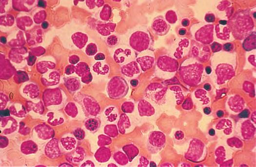 However, if the integrity of the bone marrow release process is lost through tumor infiltration, fibrosis, or other disorders, the appearance of nucleated red cells or polychromatophilic macrocytes