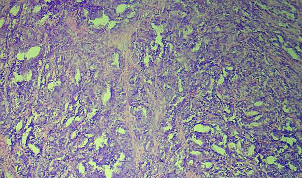 adenocarcinoma Gleason s pattern 2 loosely packed single glands