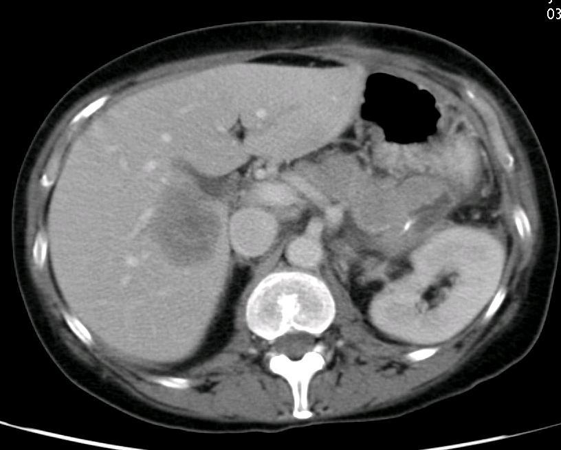 5 cm in the right lobe of the liver, likely a
