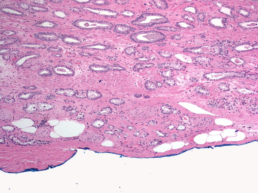 EPE - Tumor at level of or