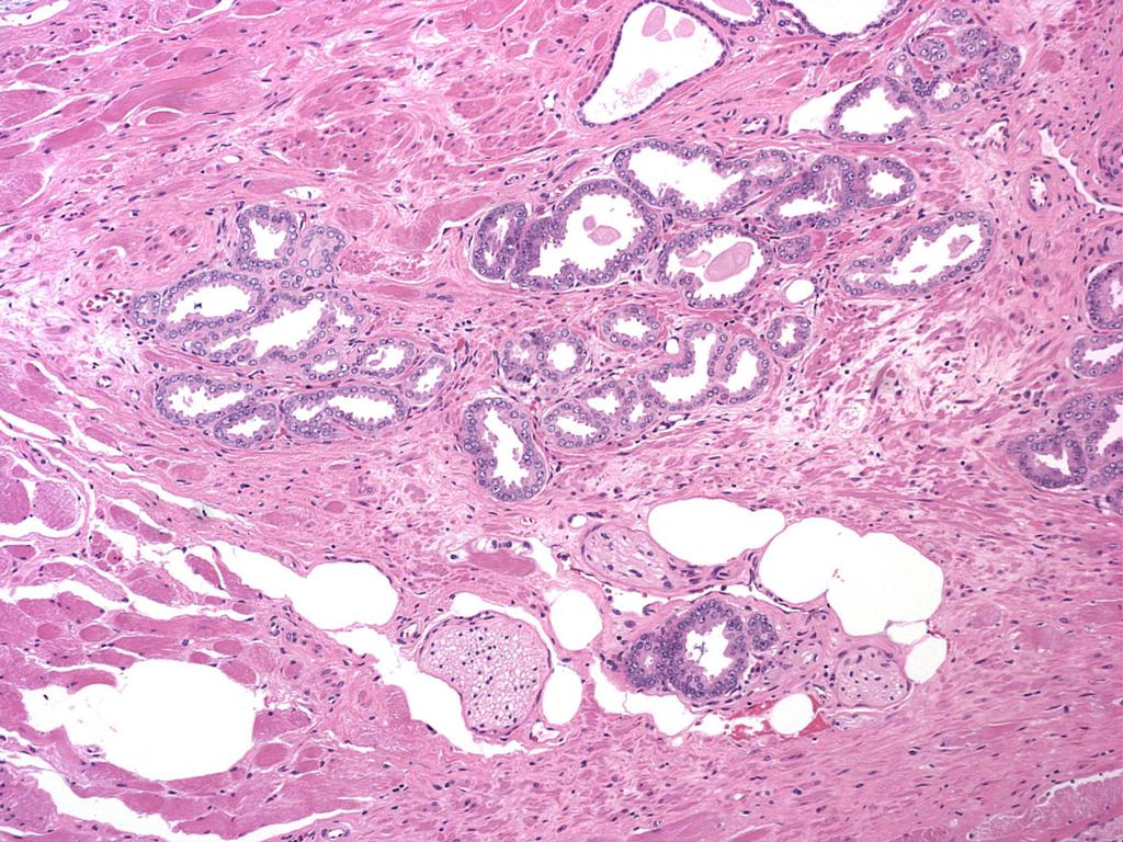 EPE - Tumor within loose