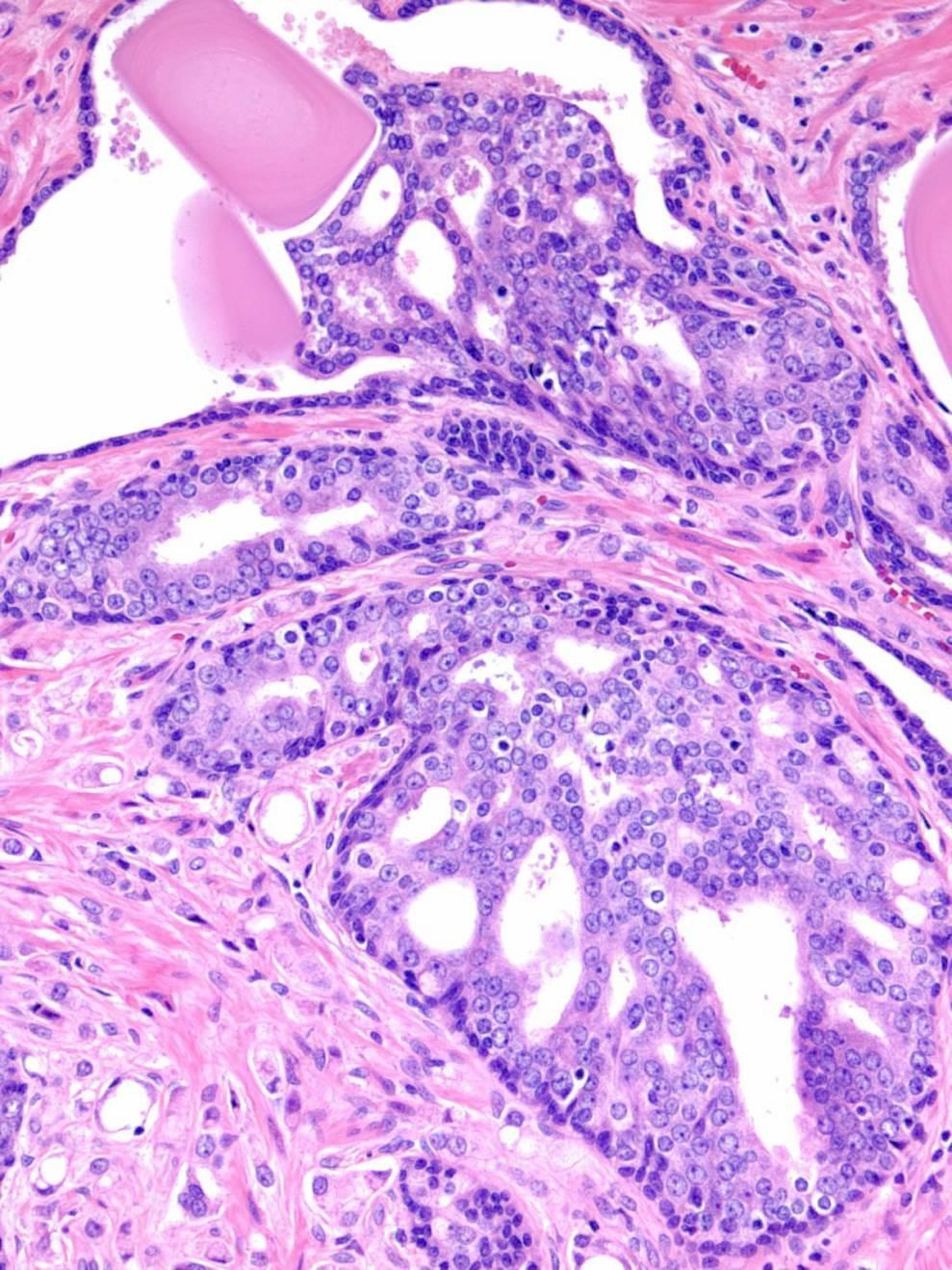 Intraductal carcinoma of the prostate (IDC-P) Distinct entity in 2016 WHO Malignant secretory cells that grow within and expand prostatic ducts/acini Associated with adverse