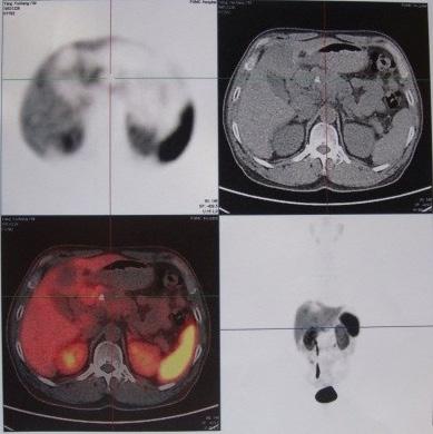 metastases. Currently the disease was in a relatively advanced stage, and the patient also had the symptoms of carcinoid syndrome. A combined therapy with sandostatin and sutent was recommended.