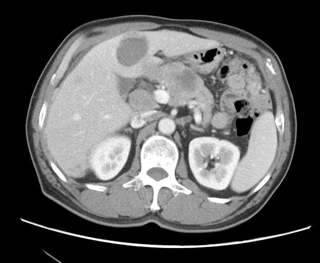 inside liver, some enlarged