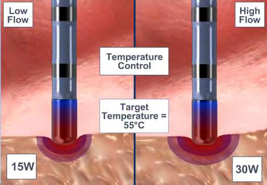 Temperature controlled ablation Effects of low and high blood flow Low blood flow: target
