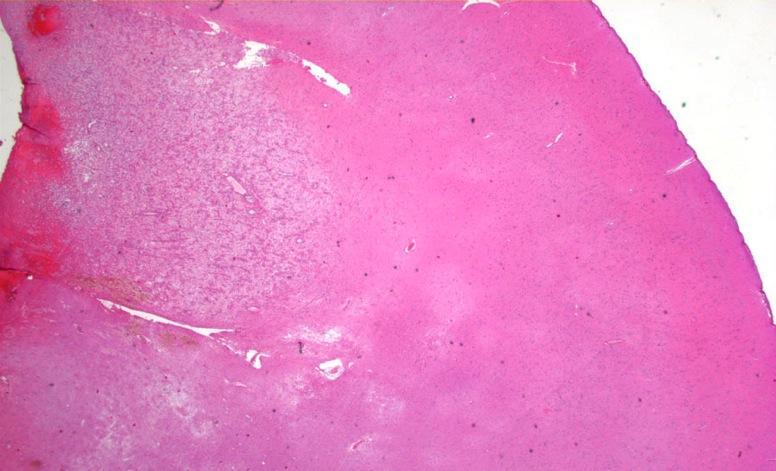 Ganglioglioma Microscopic Pathology Predominant Pattern Type Ill-defined lobules, non-infiltrative growth Predominant Cell Type Ganglion cells Wrong location Wrong