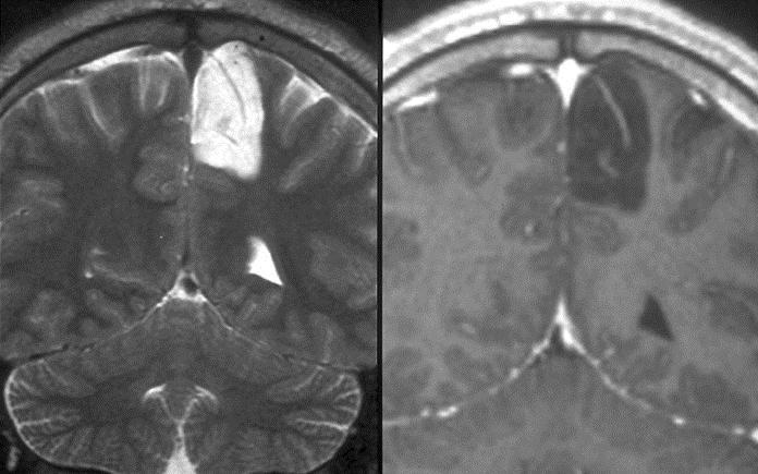 Dysembryoplastic Neuroepithelial Image Findings General Features Location Temporal lobe, particularly mesial structures Any supratentorial cortex Erosion,