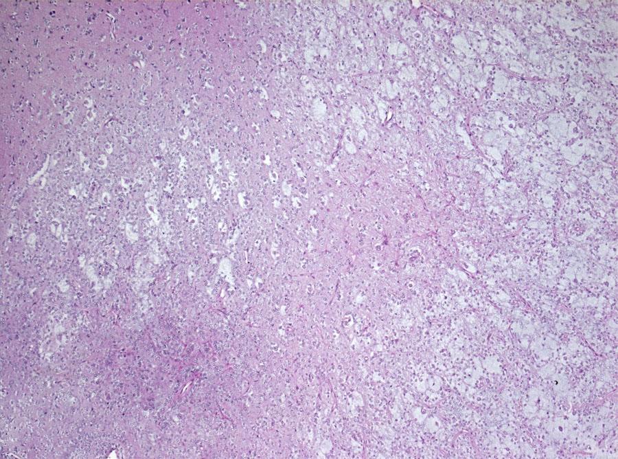 Dysembryoplastic Neuroepithelial Microscopic Pathology Cont d.